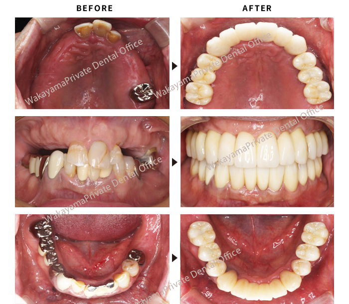 症例① インプラント治療