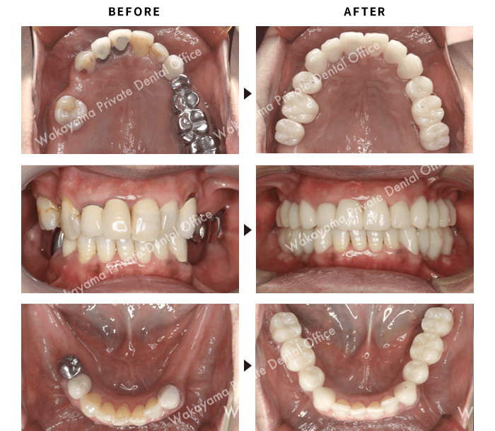 症例① インプラント治療