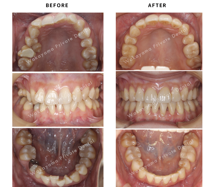 症例⑫ 30代女性・歯並びの改善と被せ物による治療