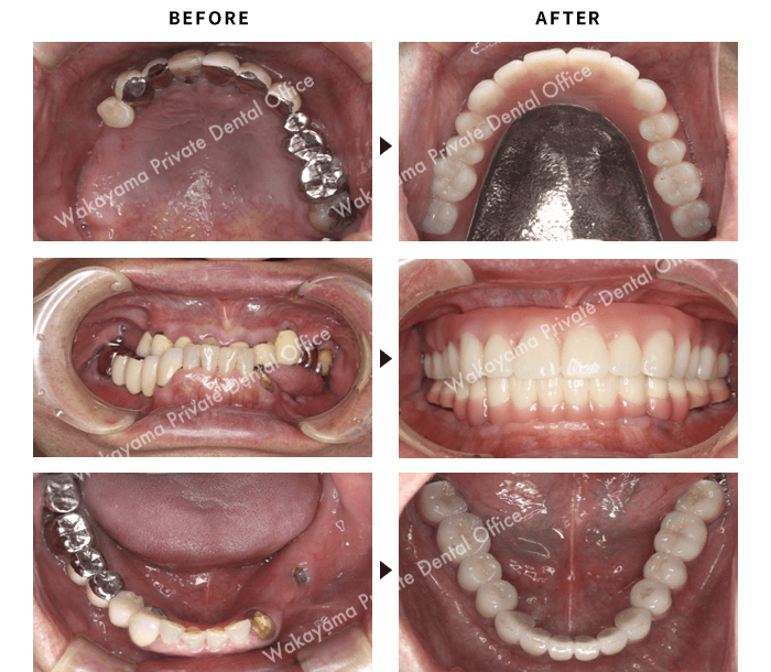 症例② 噛み合わせ治療、インプラント治療